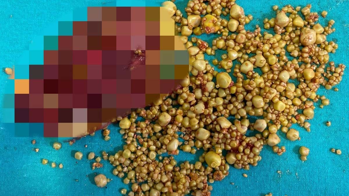 Safra kesesinden 1284 adet taş çıktı