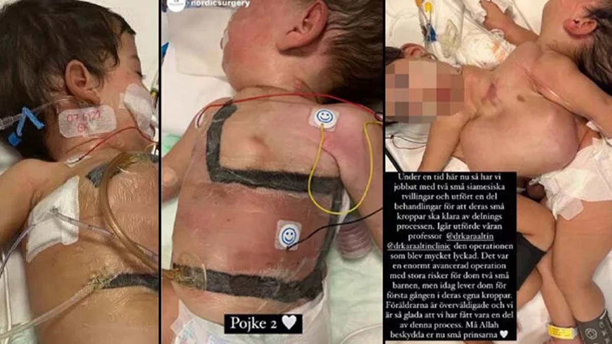 Siyam ikizleri 9 saatlik ameliyatla ayrıldı