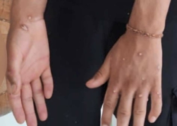 Sultangazi'de Maymun çiçeği paniği