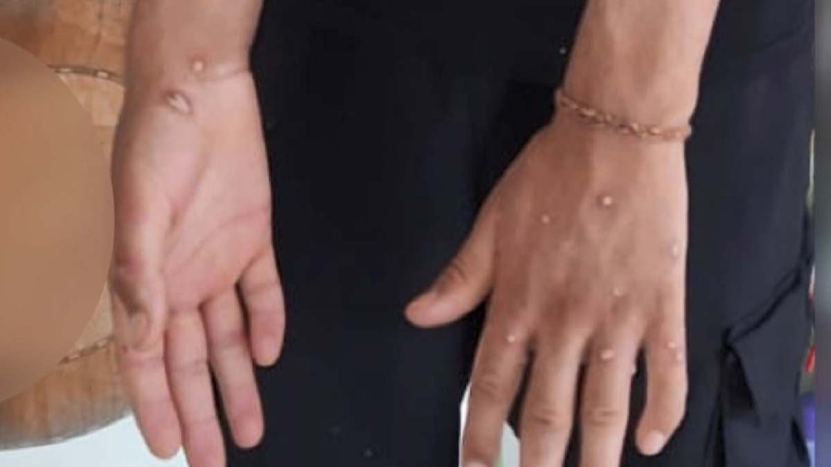 Sultangazi'de Maymun çiçeği paniği