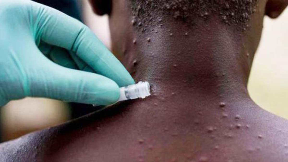 Uzmanlar, Maymun Çiçeği virüsü için toplanacak