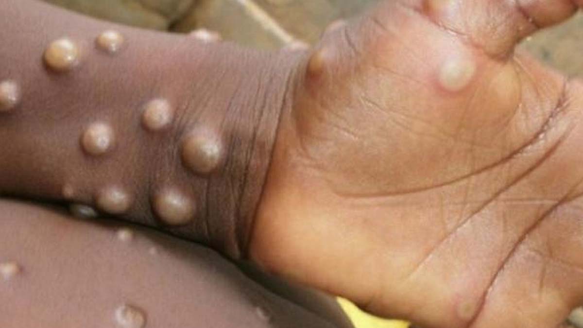 Türkiye'de maymun çiçeği vakası görüldü