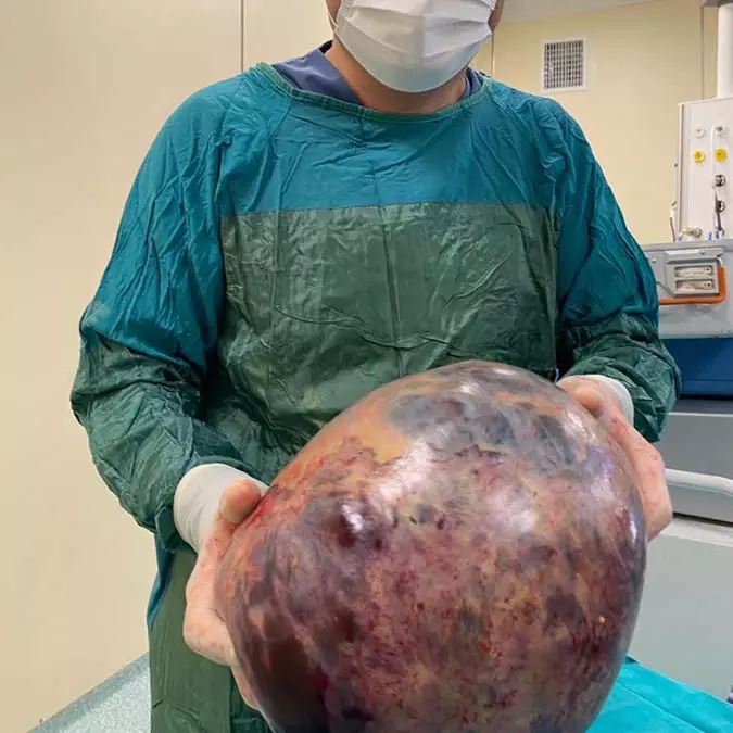 Karnindan 10 kilo tumor cikarildi 2 - yaşam - haberton