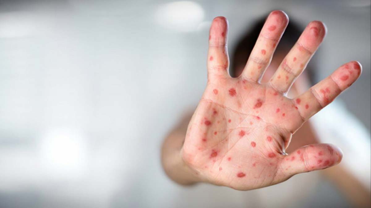 Maymun çiçeği vakaları üçe katlandı