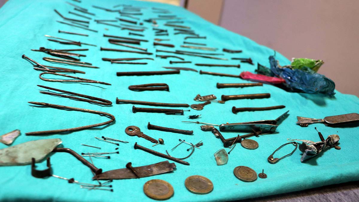 Midesinden 158 parça metal çıkarıldı