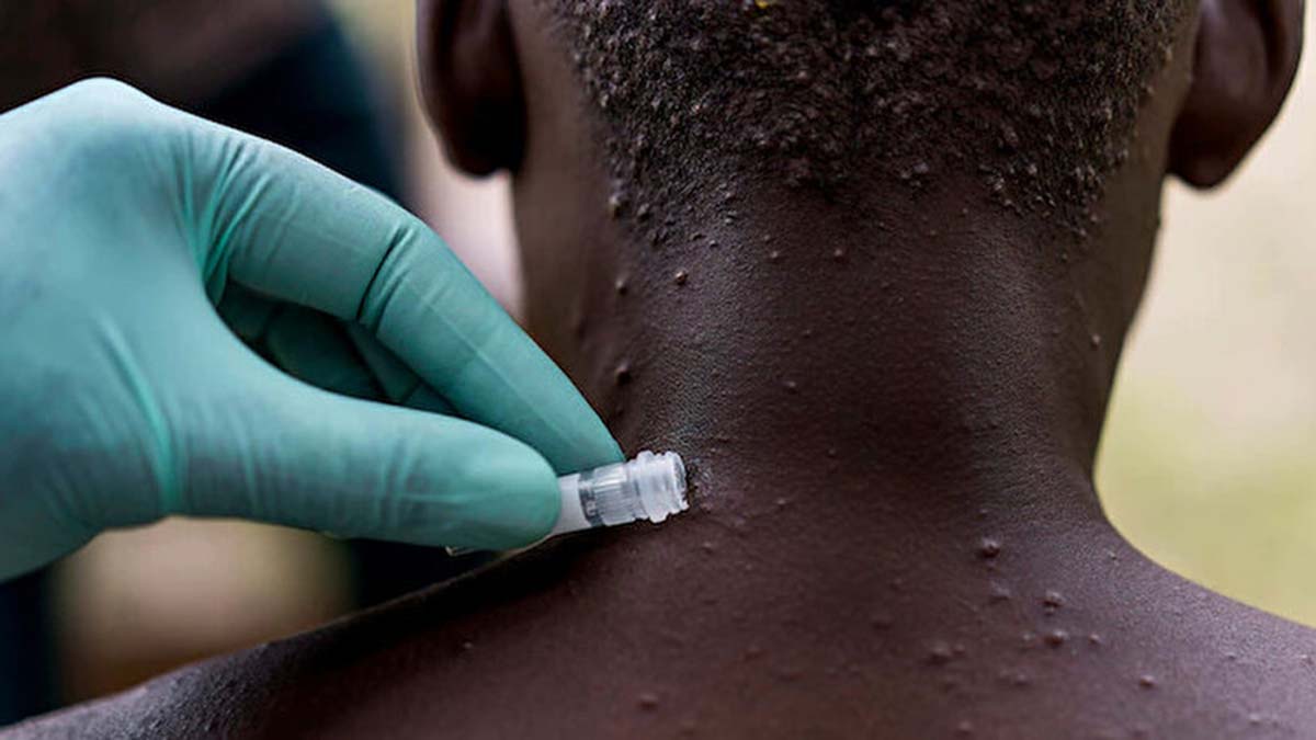 New York'ta maymun çiçeği: acil durum ilan edildi