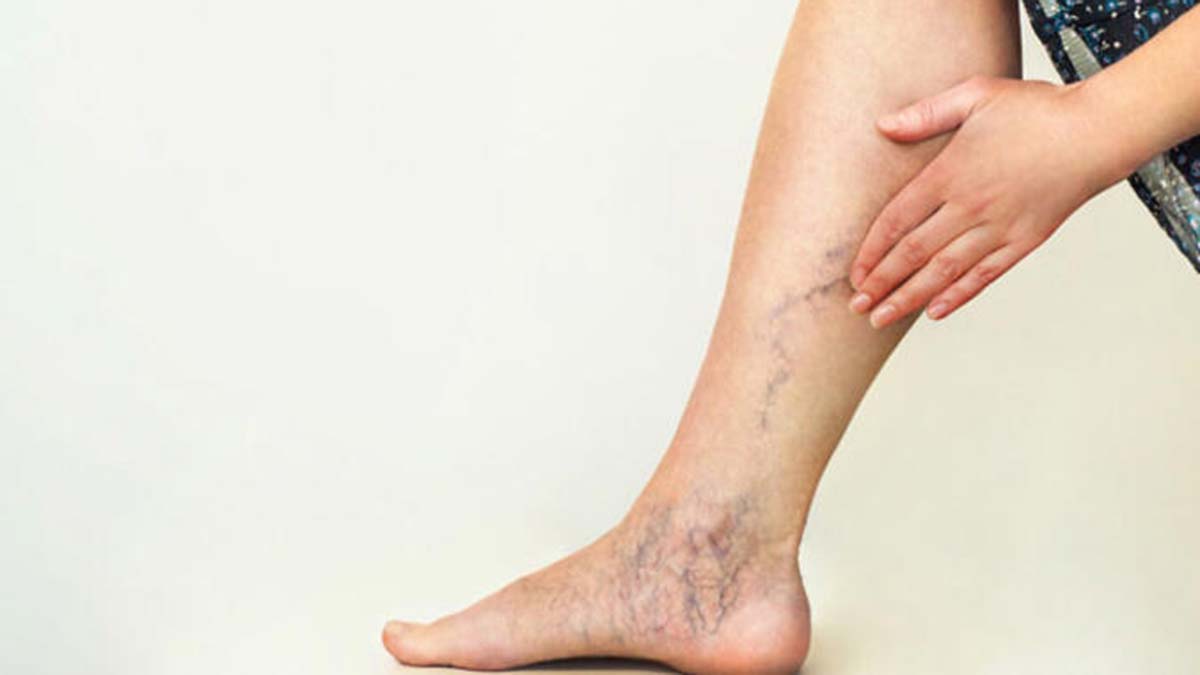 Varis oluşumunun sebepleri nelerdir?