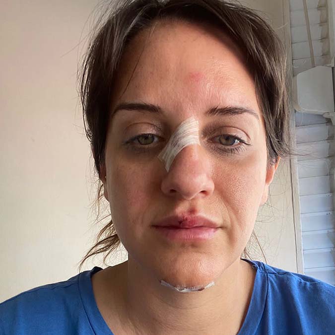 Cerrahpaşa Tıp Fakültesi Estetik Plastik ve Rekonstrüktif Cerrahi Uzmanı Doç. Dr. Semih Bağhaki, "Son 2-3 yıldır giderek artan ve artacak gibi de gözüken bir yaralanma grubu elektrikli skuter kazaları. Baş ve boyun bölgesi ile el kol kemikleri en sık görülen yaralanmalar" dedi.