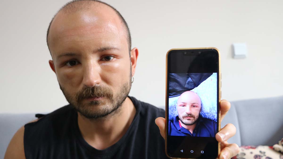 Başında nadir görülen sıcak ödemi oluştu