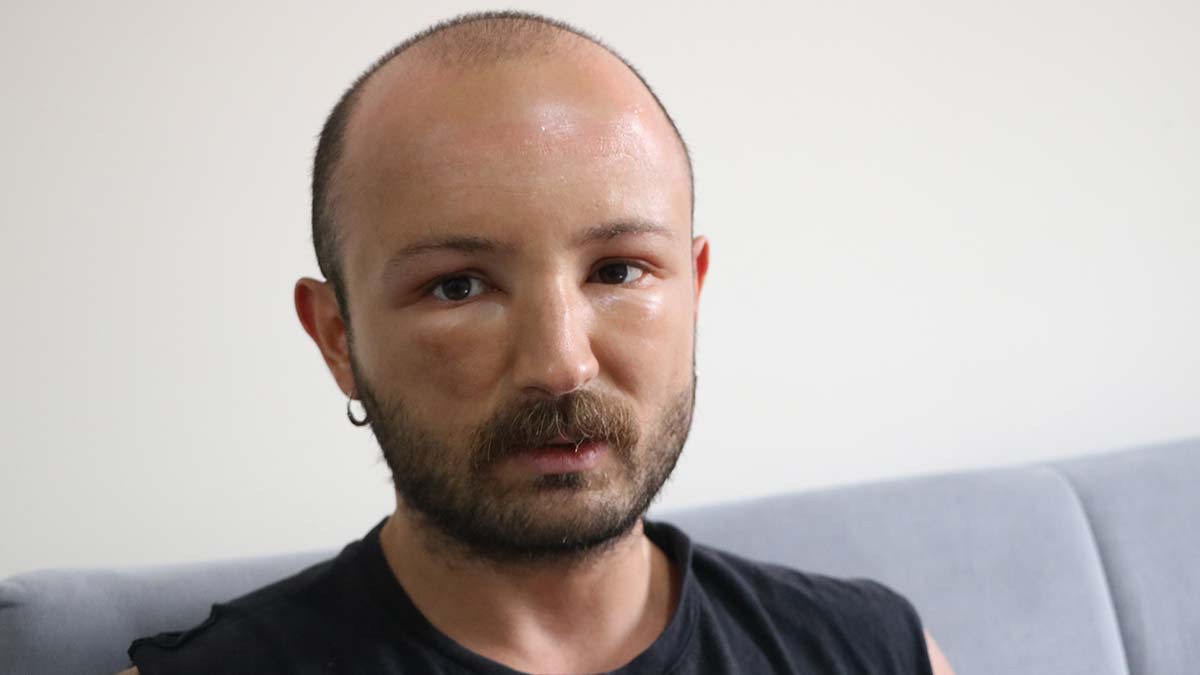 Zonguldak'ta, 2 gün üst üste denize giren Caner Arık'ın (33) başında, daha çok sıcak havalarda el ve ayaklarda görülen sıcak ödemi meydana geldi.