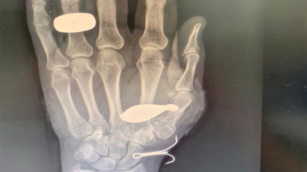 Balık kurşunu el kemiğine saplandı