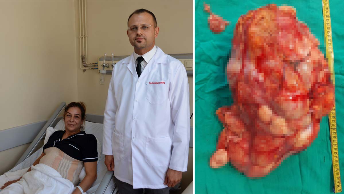 Karnından, 10 kiloluk kanserli kitle çıkarıldı