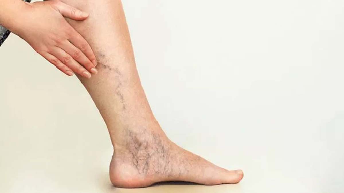 Varis hastalığında genetik özellikler etkiliyor