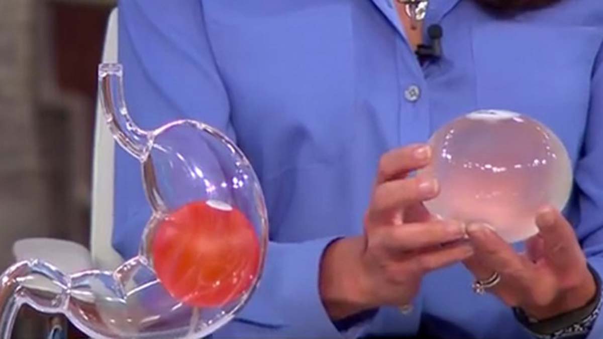 Yutulabilir mide balonu nedir?