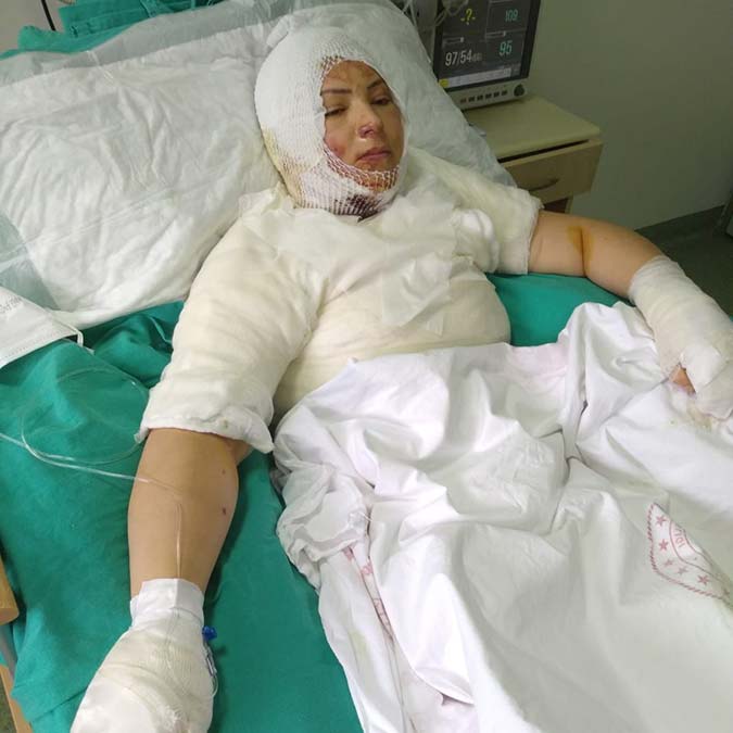 Ordu'da, eski eşi Elvan Sözkesen'in (38) üzerine yanıcı madde döküp yaktığı suçlamasıyla tutuklanan Erkan Emiroğlu için mahkeme heyeti, tutukluluk halinin devamına, Elvan Sözkesen için kati raporu talep etti.