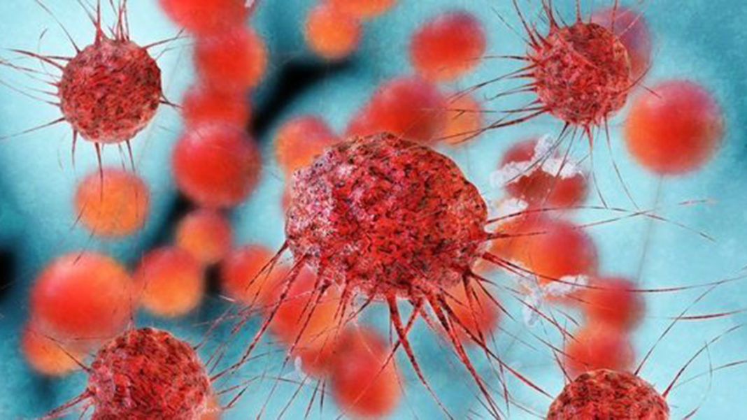 CAR-T hücre tedavisi meme kanserine umut oldu