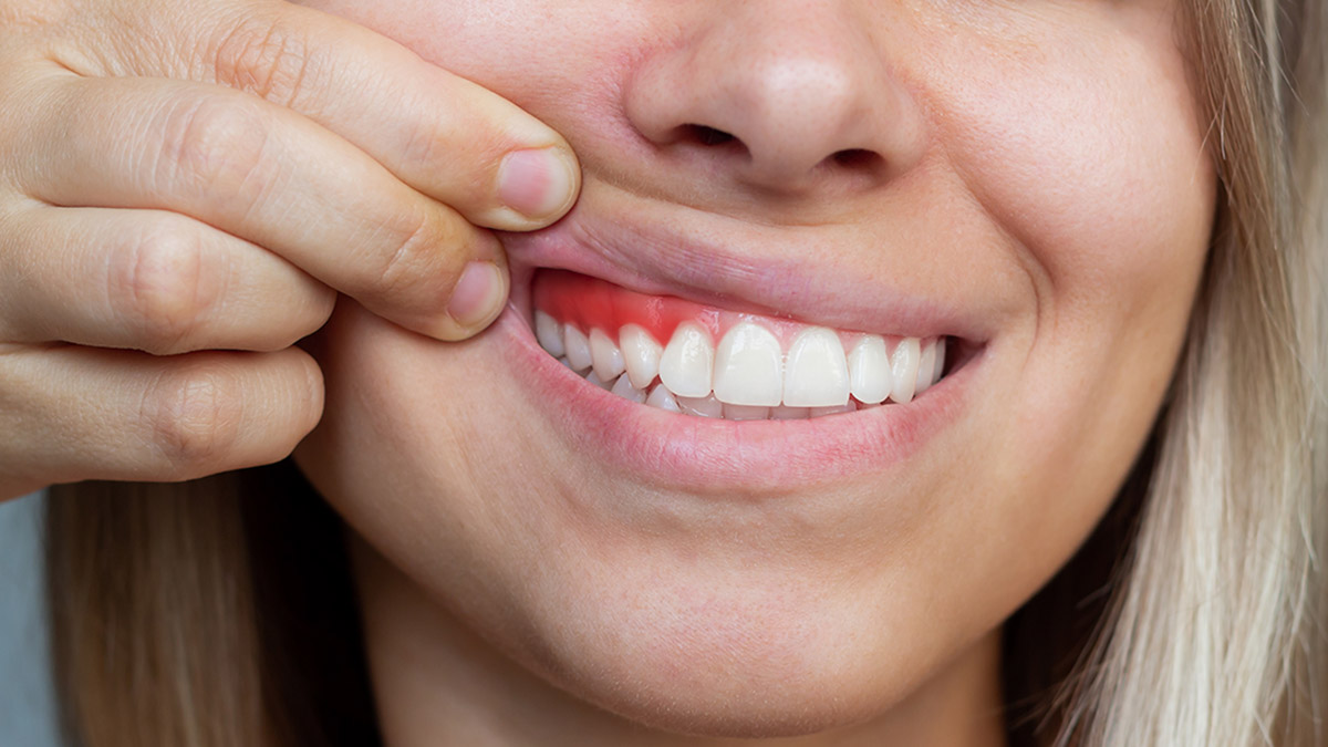 Diş etinde şişkinlik ve kırmızılığa dikkat!