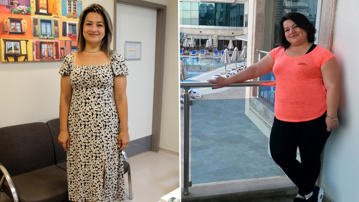 Mide küçültme ameliyatıyla 8 ayda 41 kilo verdi