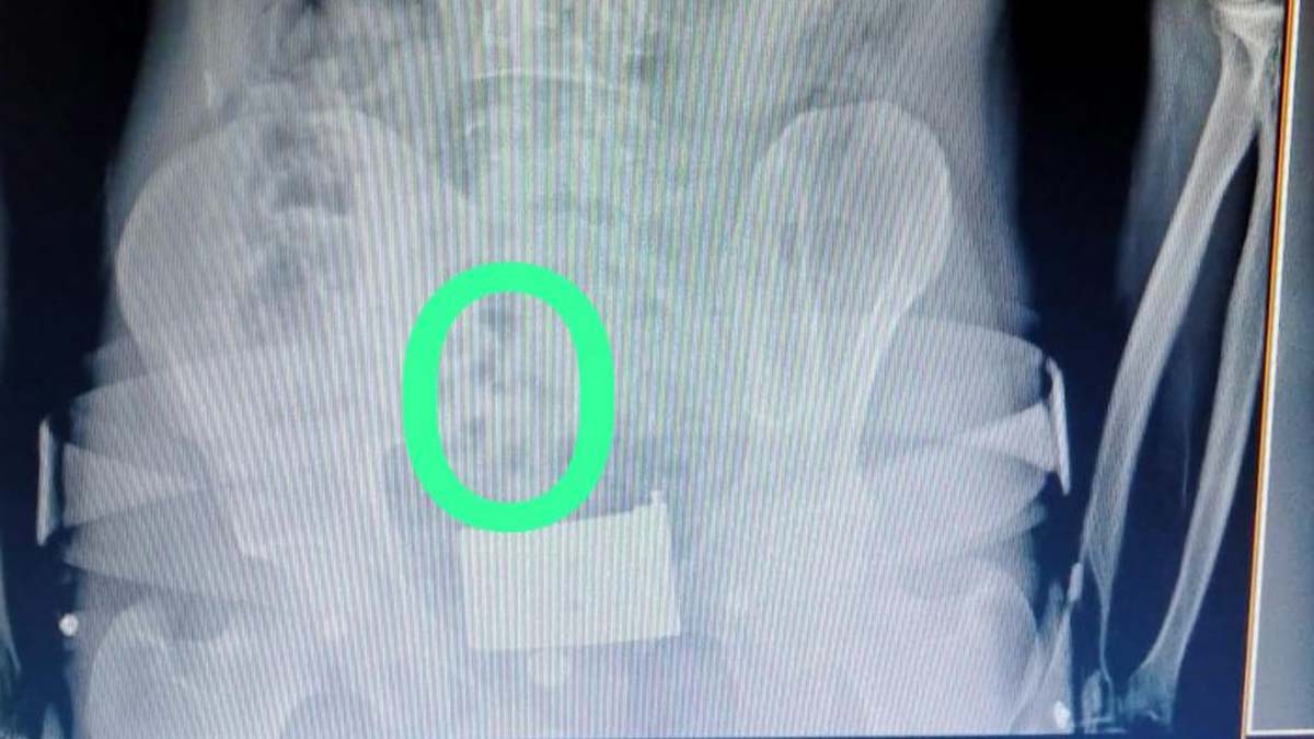 Şüpheli 2 kişinin midesinden eroin çıkarıldı