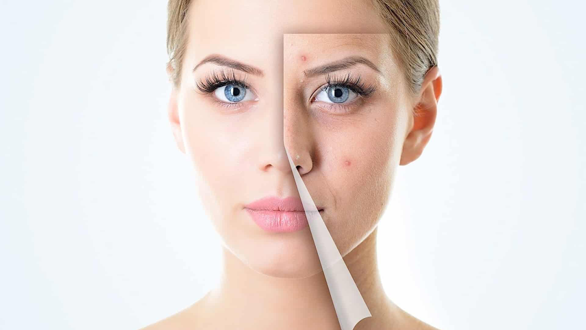 Akne izleriyle vedalaşın!