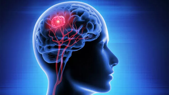 Beyin kanamasina neden olan faktorlere dikkat 1 - sağlık haberleri - haberton