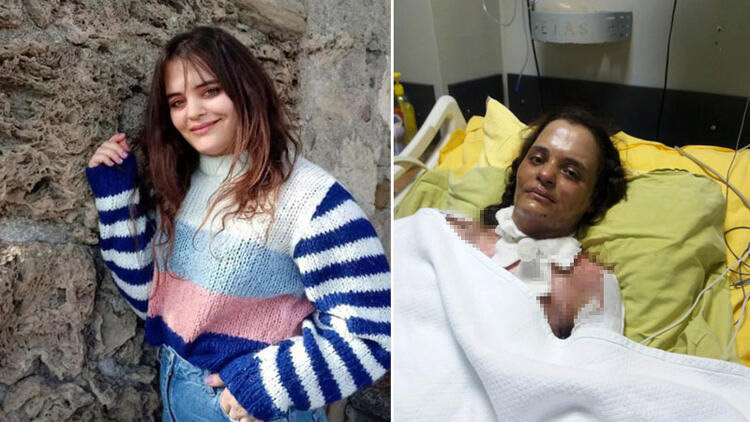 Dezenfektanın parlamasıyla yanan Havva yoğun bakımda