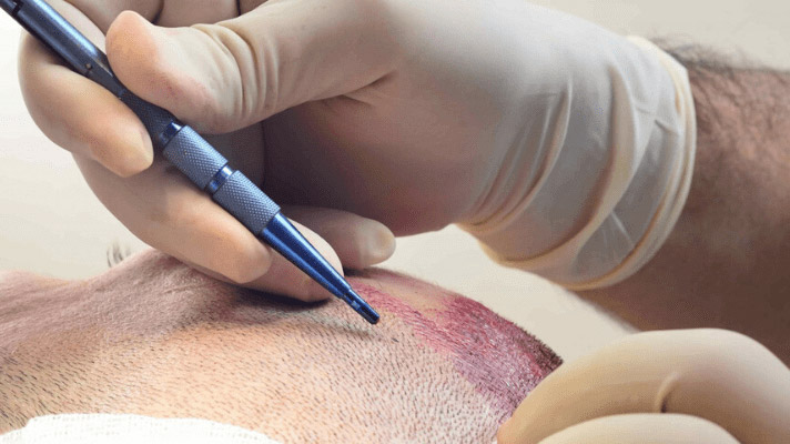 Safir saç ekimiyle doğal saç görünümü mümkün