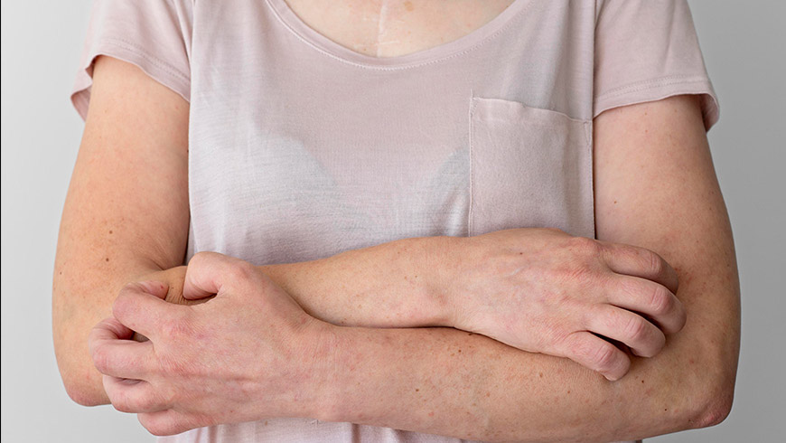 Son 3-5 yıldır uyuz, Türkiye'de salgın şeklinde