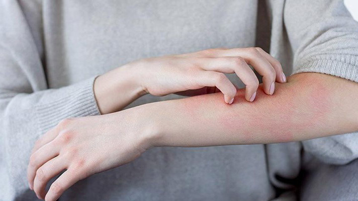 Uyuz salgını yüzünden yapma ilaçlara döndük