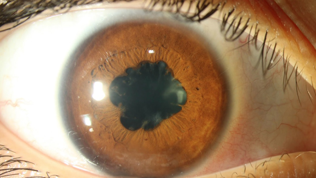 Göz iltihaplanması görme kaybına neden olabilir