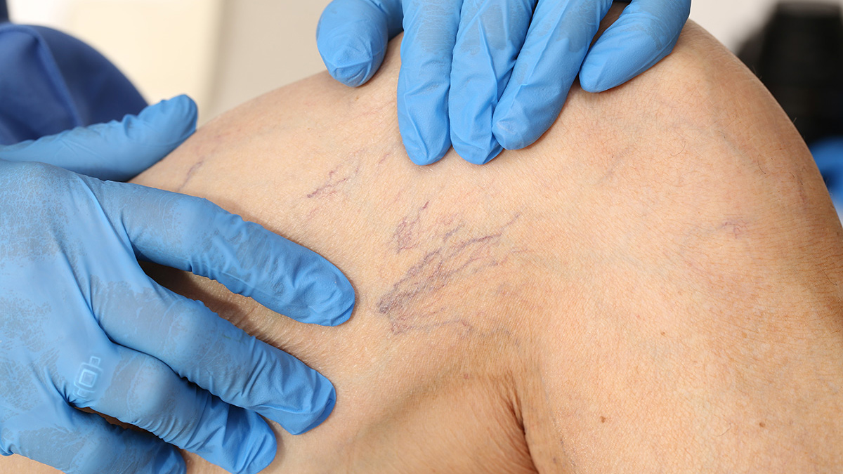 Varis ameliyatları sonrasında varisler nüksedebiliyor