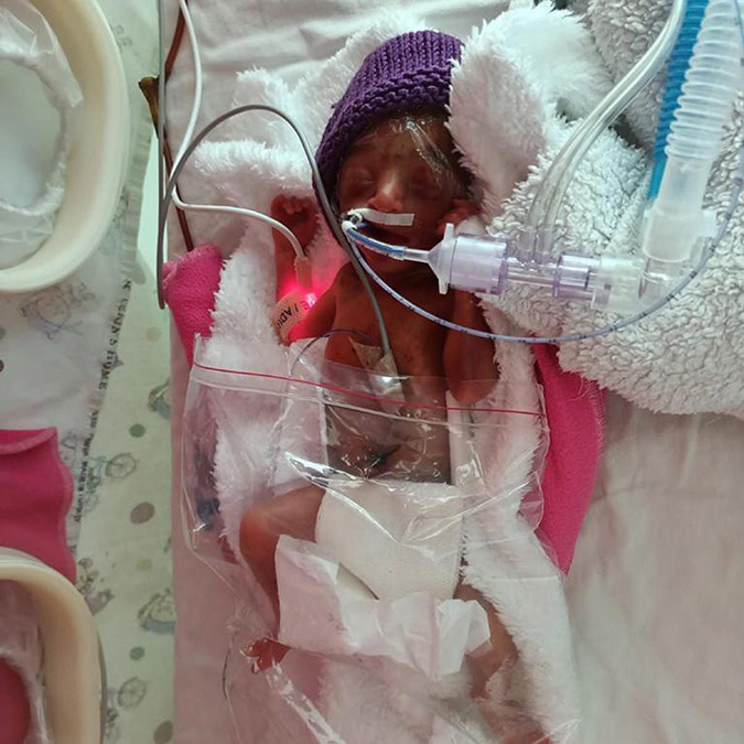 710 gram doğan Arden bebek yaşama tutundu