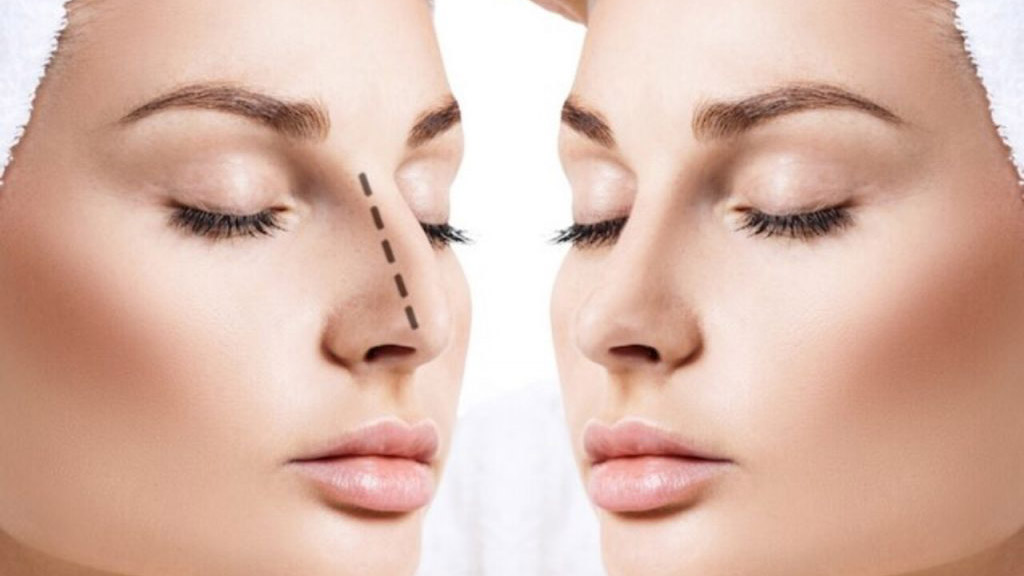 Burun estetiğinde doğru bilinen 5 yanlış