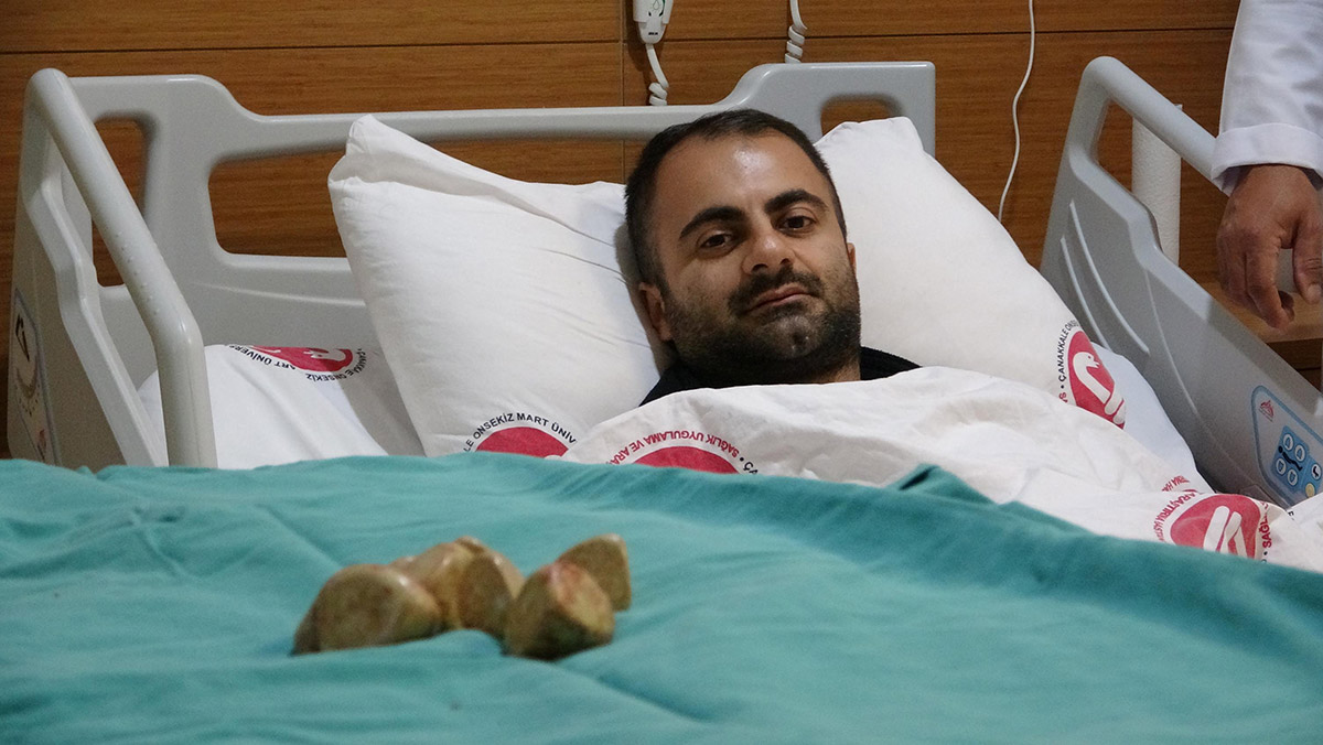 Mesanesinden 550 gram ağırlığında 20 taş çıkarıldı