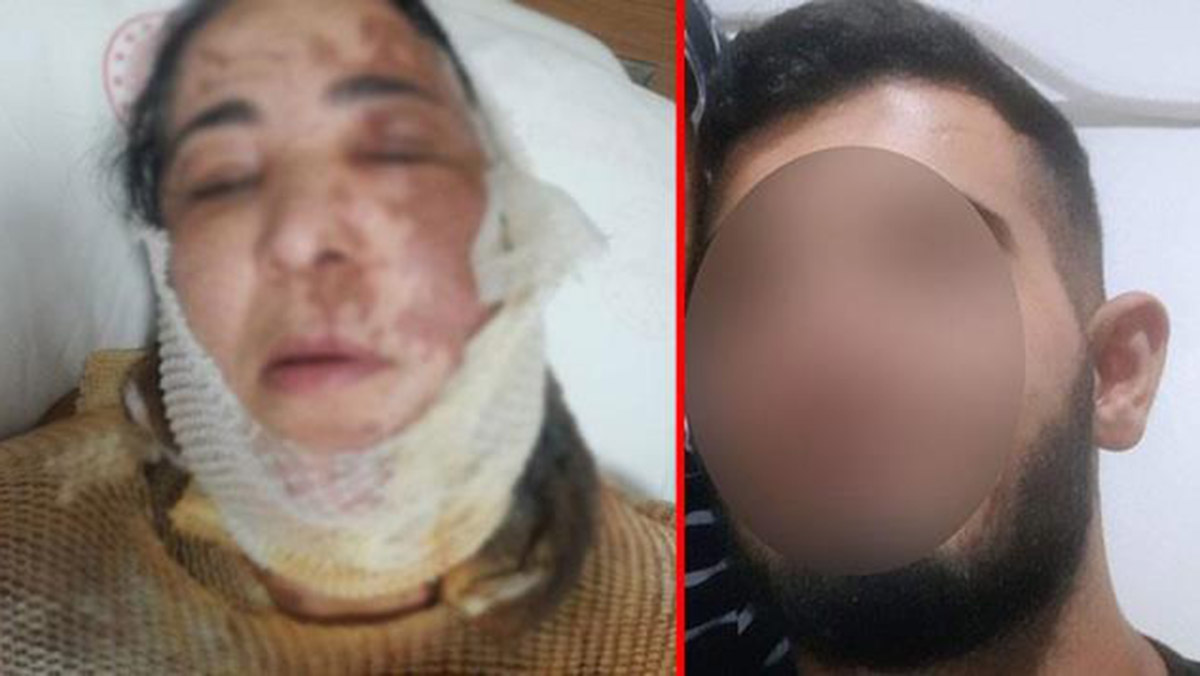 Üvey oğlunun kezzaplı saldırısına uğradı