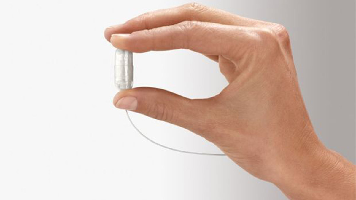 Yutulabilir mide balonu nedir?