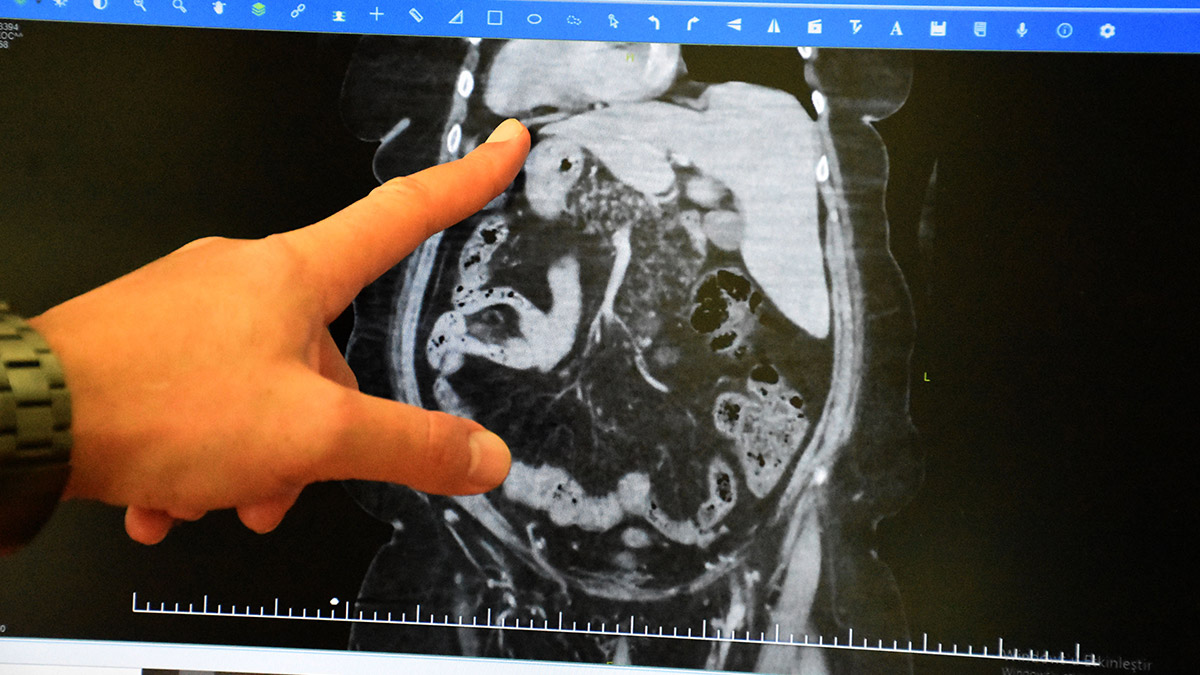 İç organları ters olan hasta ameliyat oldu