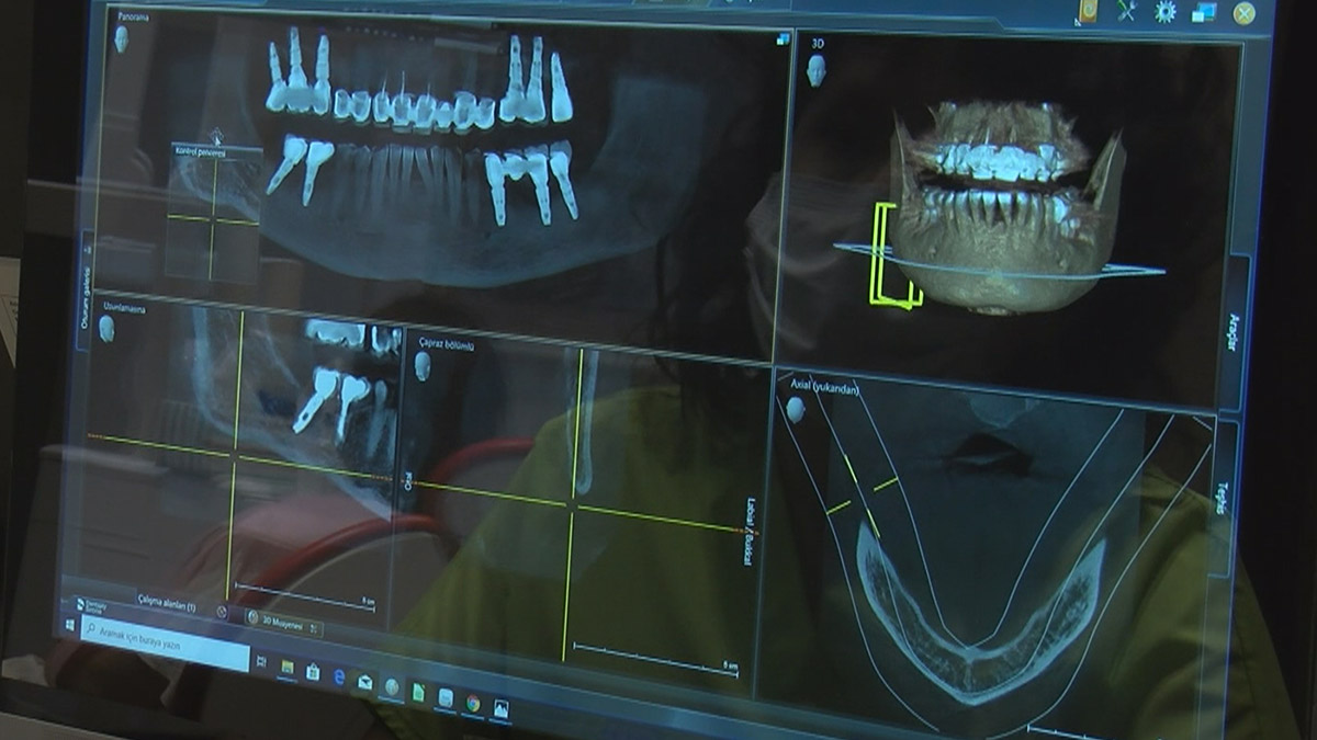 "Hollywood Gülüşü", "Turkish Smile", ya da daha pek çok farklı moda trendi ile özellikle sosyal medyadan pompalanan "bembeyaz dişler" modasına karşı uzmanlar uyarıyor
