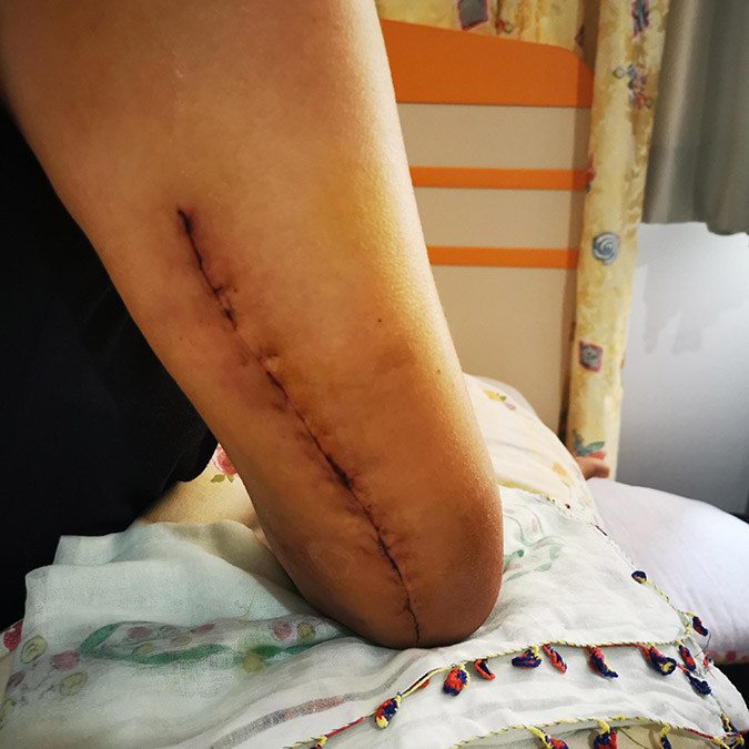 İzmir'de, kız arkadaşının kolunu kıran sanık Melih Gazi Çıbıkçı'ya (30) 2 ay ertelemeli olarak verilen 10 ay hapis, istinafta bozuldu.