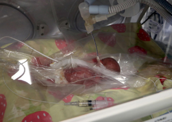 310 gram doğan bebek, yaşam savaşı veriyor
