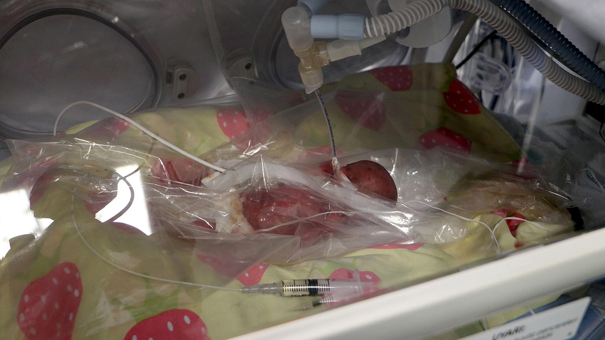 310 gram doğan bebek, yaşam savaşı veriyor