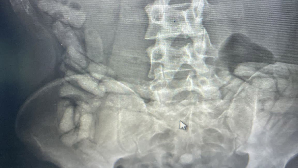 Bağırsaklarından 432 gram Afyon sakızı çıktı