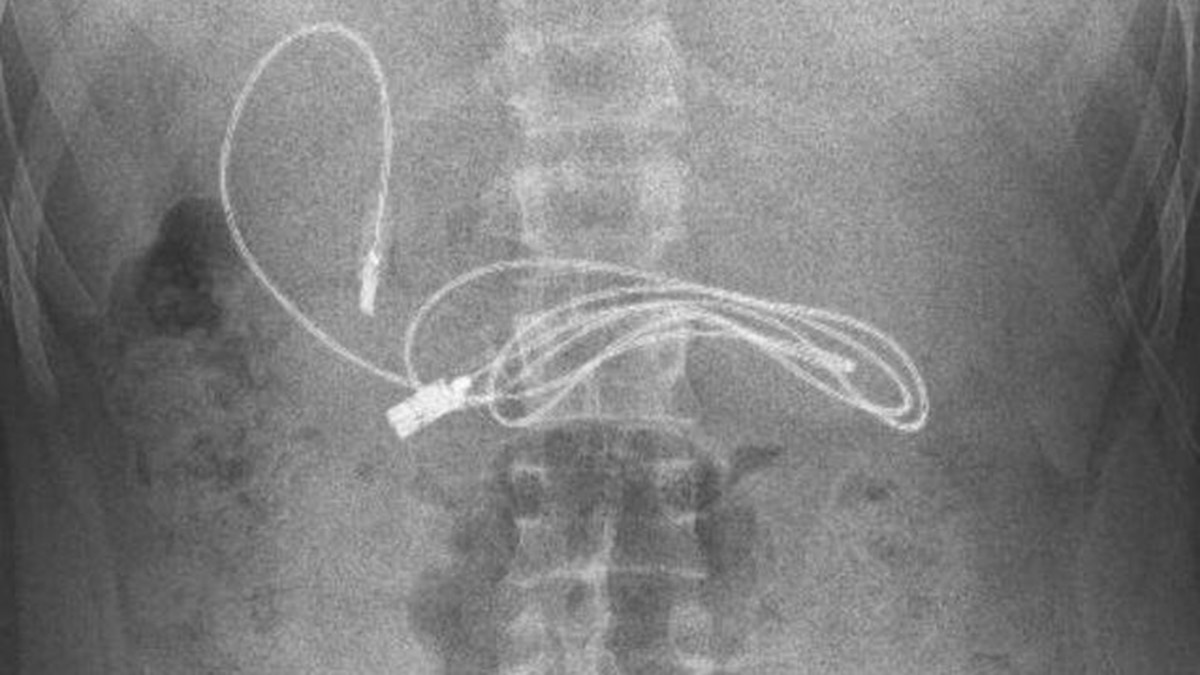 Çocuğun midesinden 1 şarj kablosu ve toka çıktı