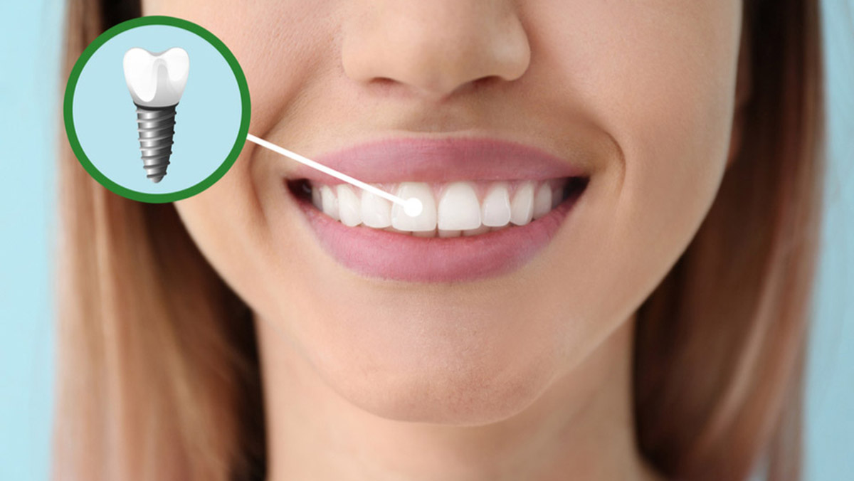 İmplant hakkında doğru bilinen yanlışlar