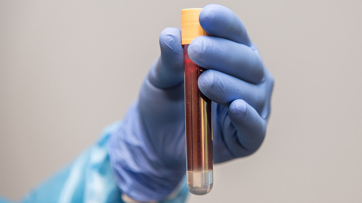 Alzheimer'ı teşhis eden kan testi geliştirildi