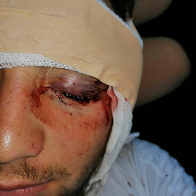 İzmir'de, 2 grup arasında çıkan kavgayı ayırmak istediği sırada yüzüne içki şişesi vurulunca sol gözünü kaybeden Egemen Öz'ün (25) yaralanmasıyla ilgili iddianame, 3 yıl sonra hazırlandı.