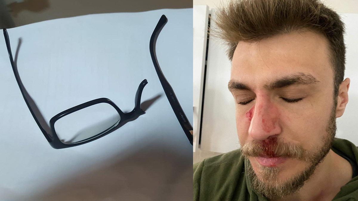 Burnu kırılan kadın doğum asistanına kafa travması teşhisi