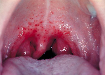 İngiltere'de Strep A'dan 122 kişi öldü