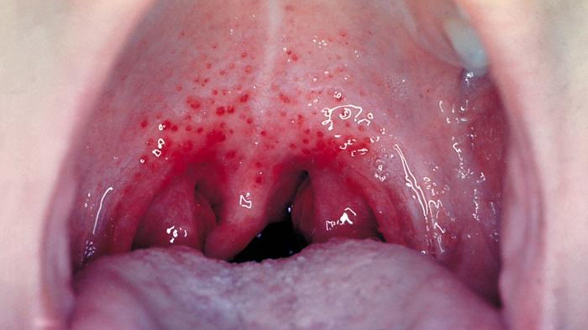İngiltere'de Strep A'dan 122 kişi öldü