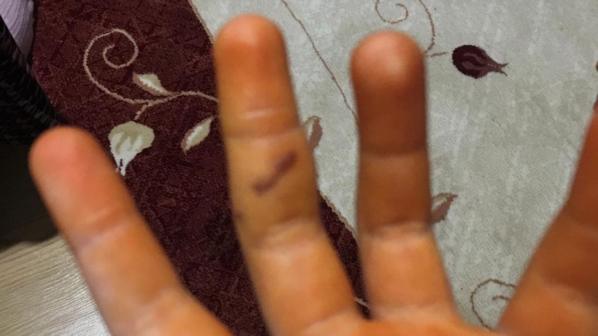 Özge sokak köpeklerinin saldırısında yaralandı